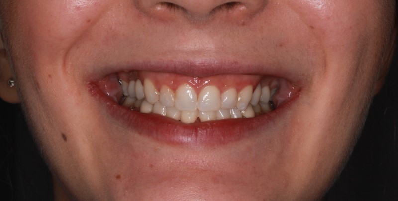Dívka s 9ti nezaloženými zuby