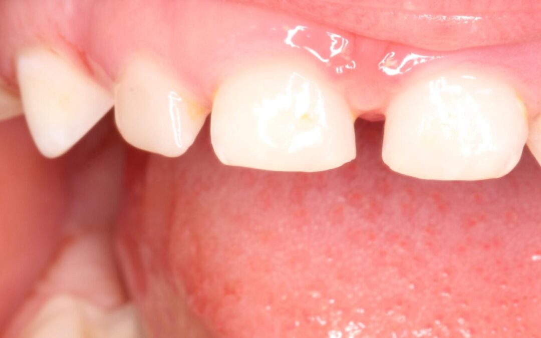 Ošetření dětských zubů – pacient v sedaci Midazolam