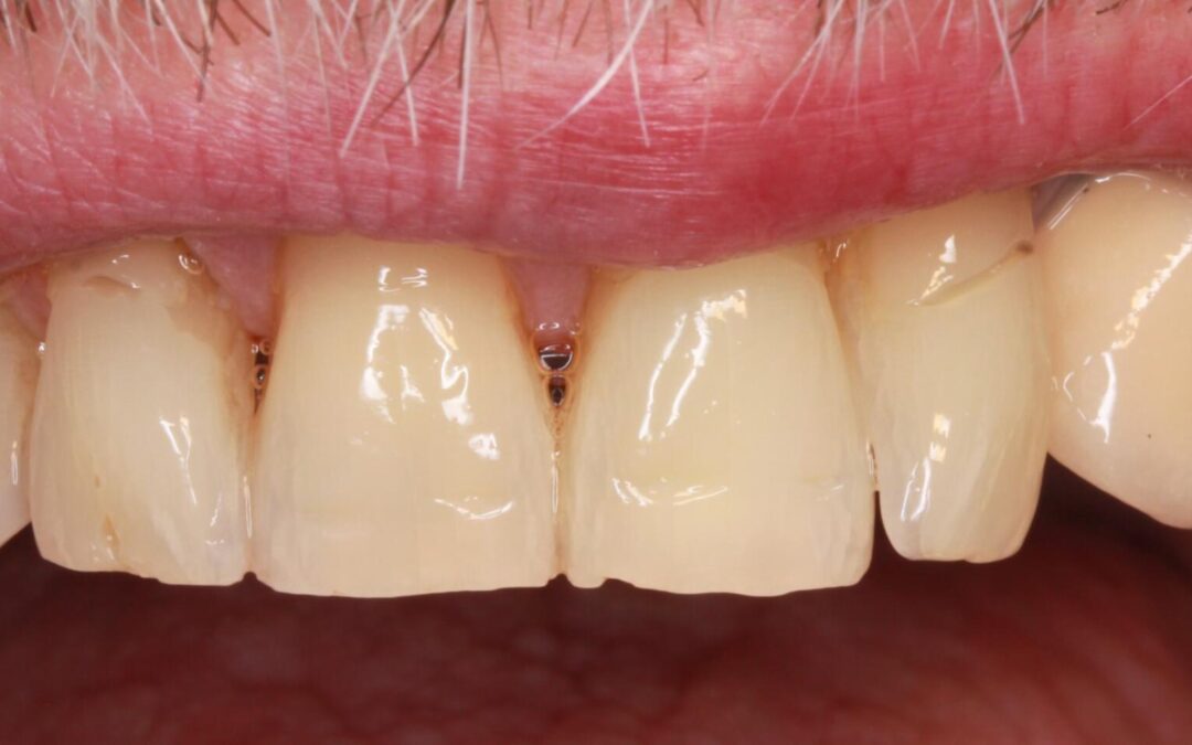 Vnitřní bělení zubů