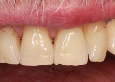Vnitřní bělení zubů