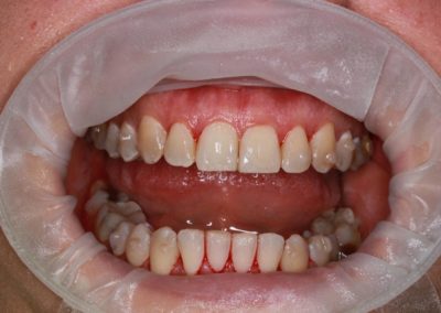 Dentální hygiena ~ před a po