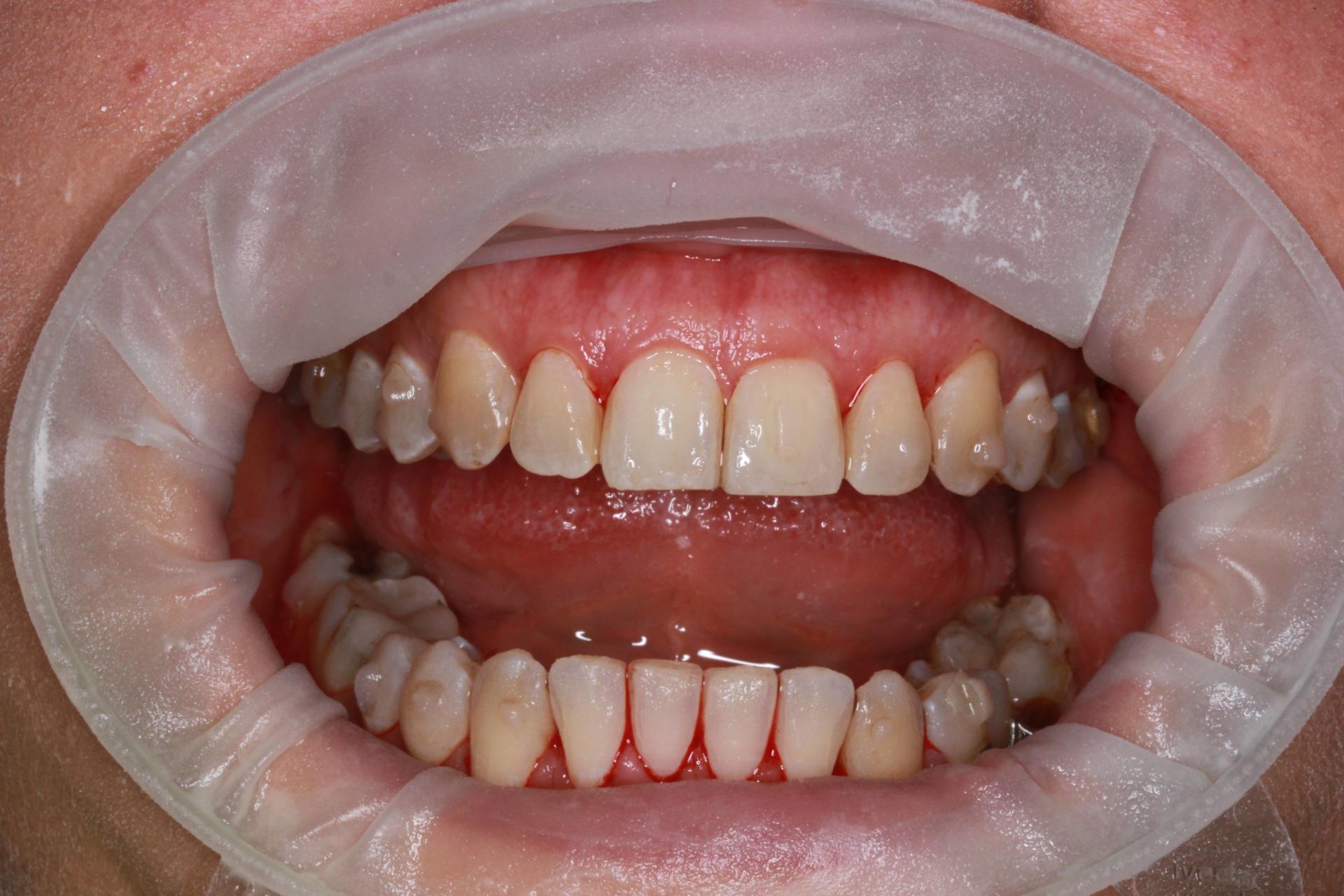 Zuby po dentální hygieně Edent Zlín, žena 45 let